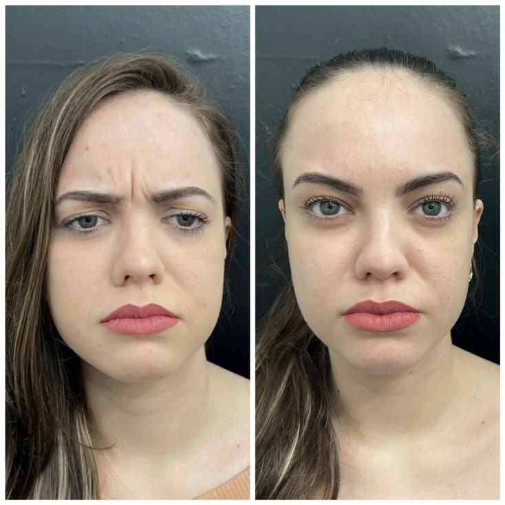 resultados-facial-1