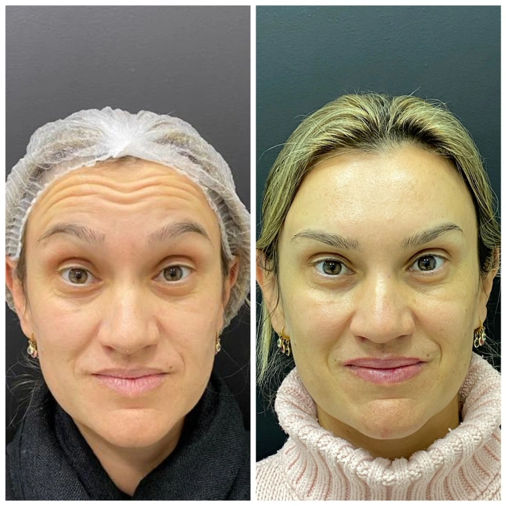resultados-facial-2