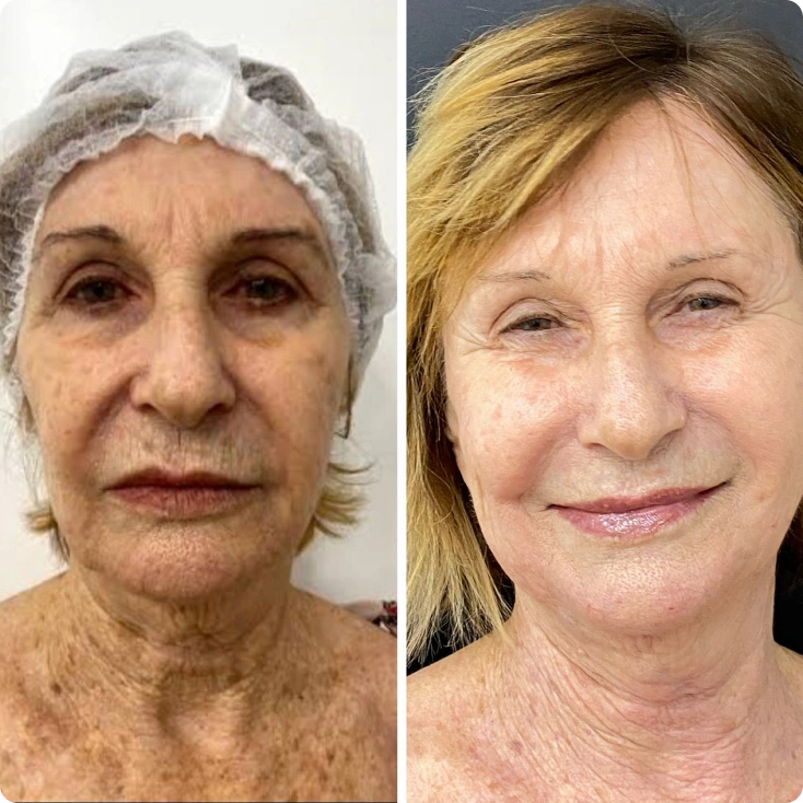 resultados-facial-3