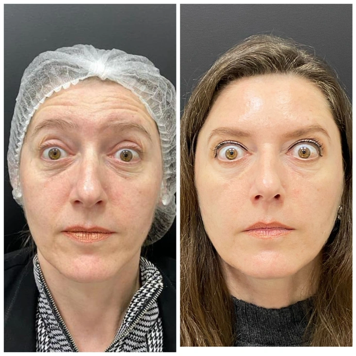resultados-facial-4