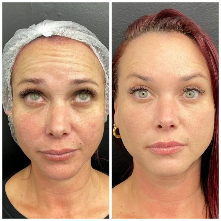 resultados-facial-5